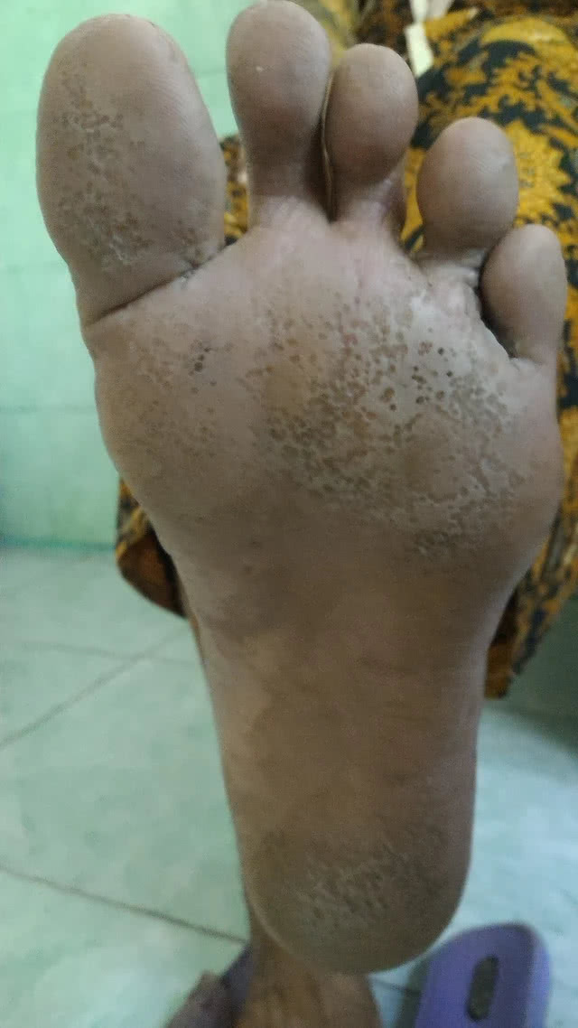 Pitted keratolysis Bahasa indonesia