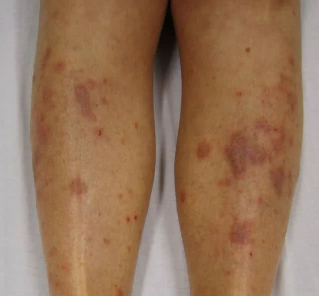 Model Dermatology Lichen Planus 9074